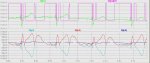 ecg_v1_672.jpg